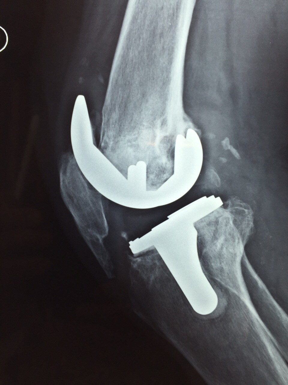 Intervento protesico del ginocchio