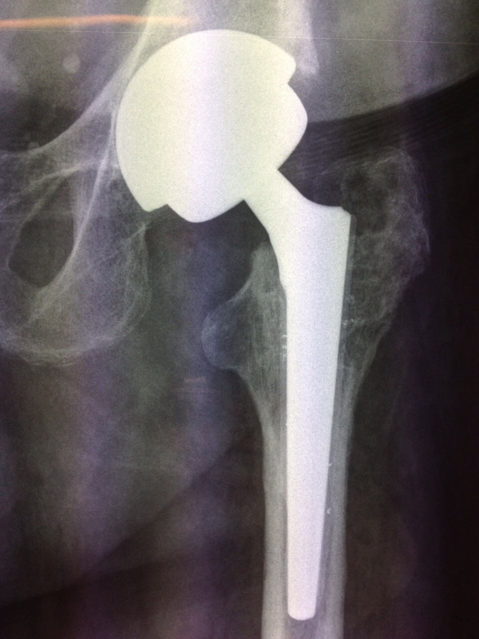 Intervento protesico dell’anca