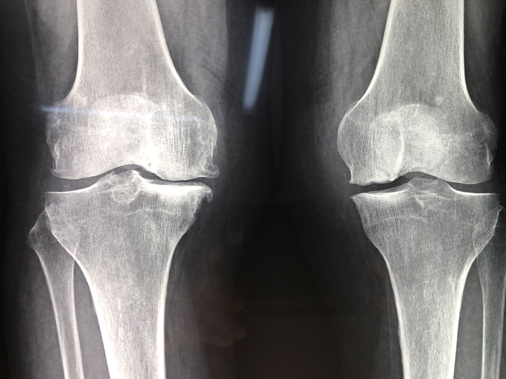 Intervento protesico del ginocchio