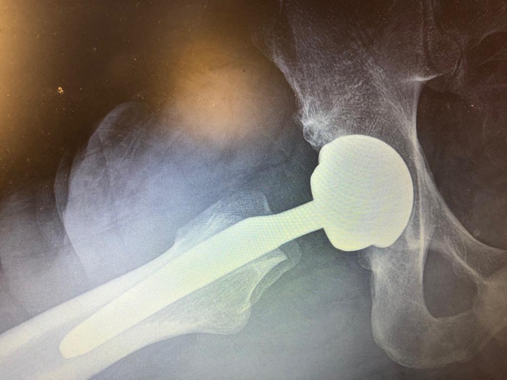 Intervento protesico dell’anca